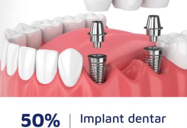 50% Reducere La Implanturi Dentare In Surrey Si Londra, UK