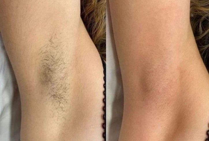 Servicii De Epilare In Woking, UK