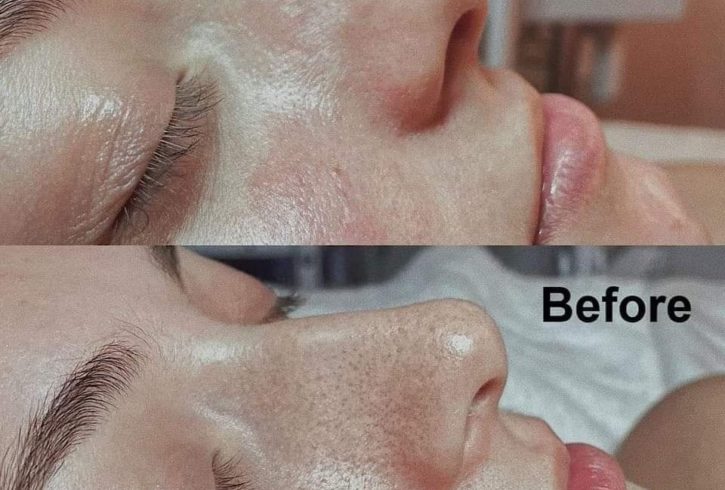 Tratamente Faciale HydraFacial In Leytonstone, Londra