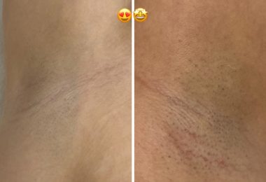 Servicii De Epilare Definitiva Cu Laser In Finchley Road, Londra