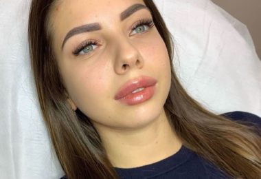 Servicii De Injectare Buze Cu Acid Hialuronic In Watford, Londra