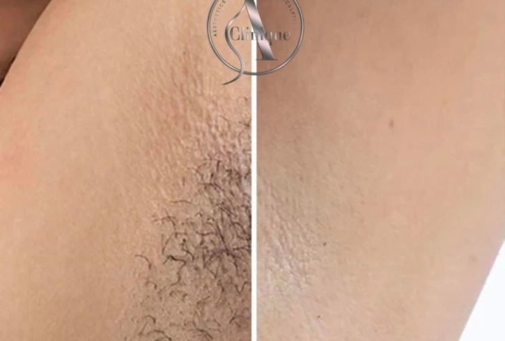 Epliare Definitiva Cu Laser In Watford, Londra