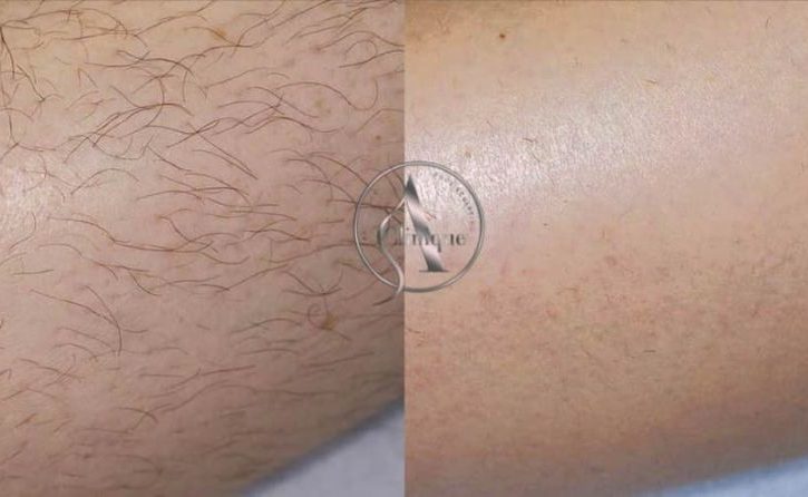 Epliare Definitiva Cu Laser In Watford, Londra