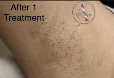 Epliare Definitiva Cu Laser In Watford, Londra