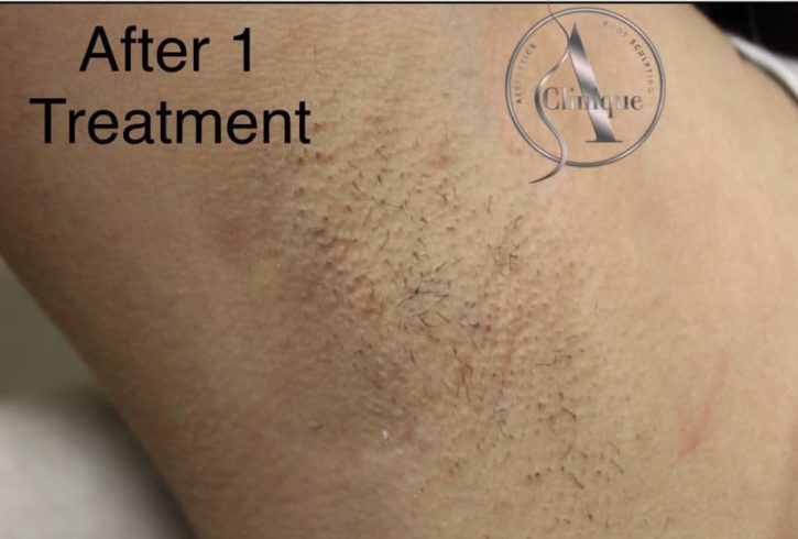 Epliare Definitiva Cu Laser In Watford, Londra