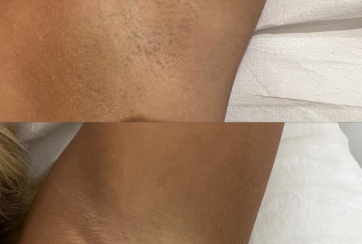 Servicii Epilare Definitiva Cu Laser in Colindale