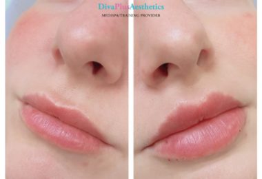 Marire Buze Cu Acid Hialuronic In Loughton, Essex