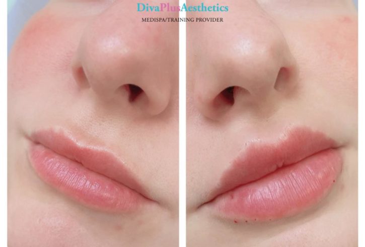 Marire Buze Cu Acid Hialuronic In Loughton, Essex