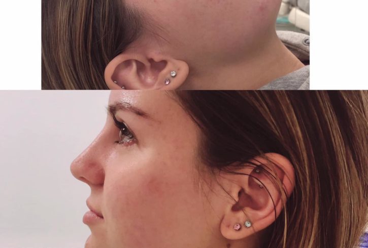 Estetica Faciala Acid Hialuronic in Woking, UK