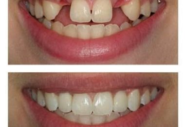 Servicii Stomatologice Implanturi in Leicester, UK