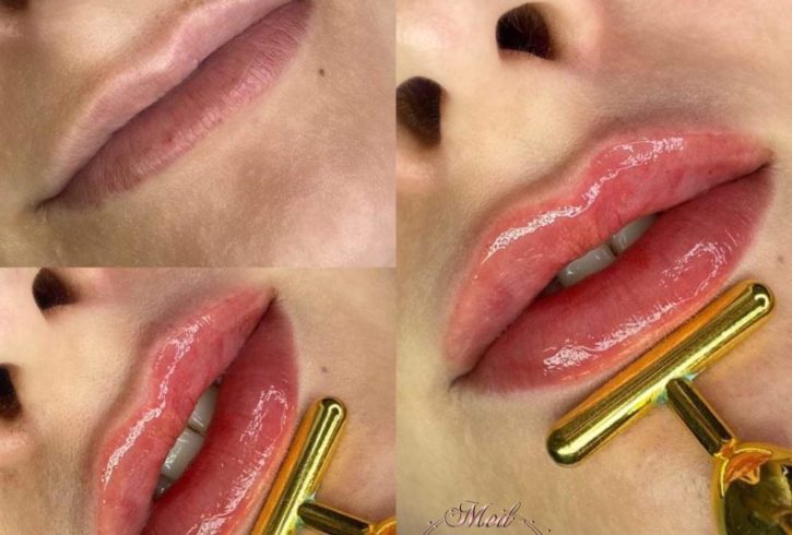 Estetica Faciala Acid Hialuronic in Woking, UK