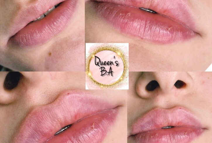 Tratamente Faciale Cu Acid Hialuronic In Edgware, Londra