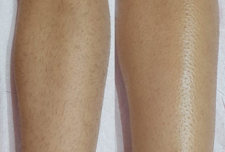 Servicii De Epilare Cu Ceara In Newham, Londra