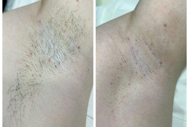 Servicii De Epilat Cu Ceara In Luton, UK