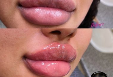 Injectare Acid Hialuronic - Russian Lips