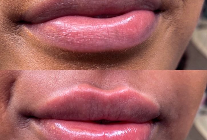 Injectare Acid Hialuronic - Russian Lips